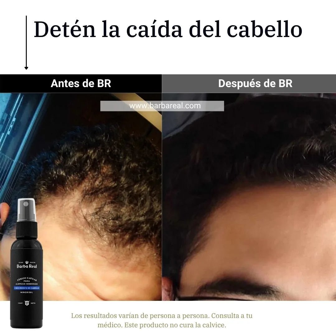 Kit Adiós Alopecia - BarbaReal