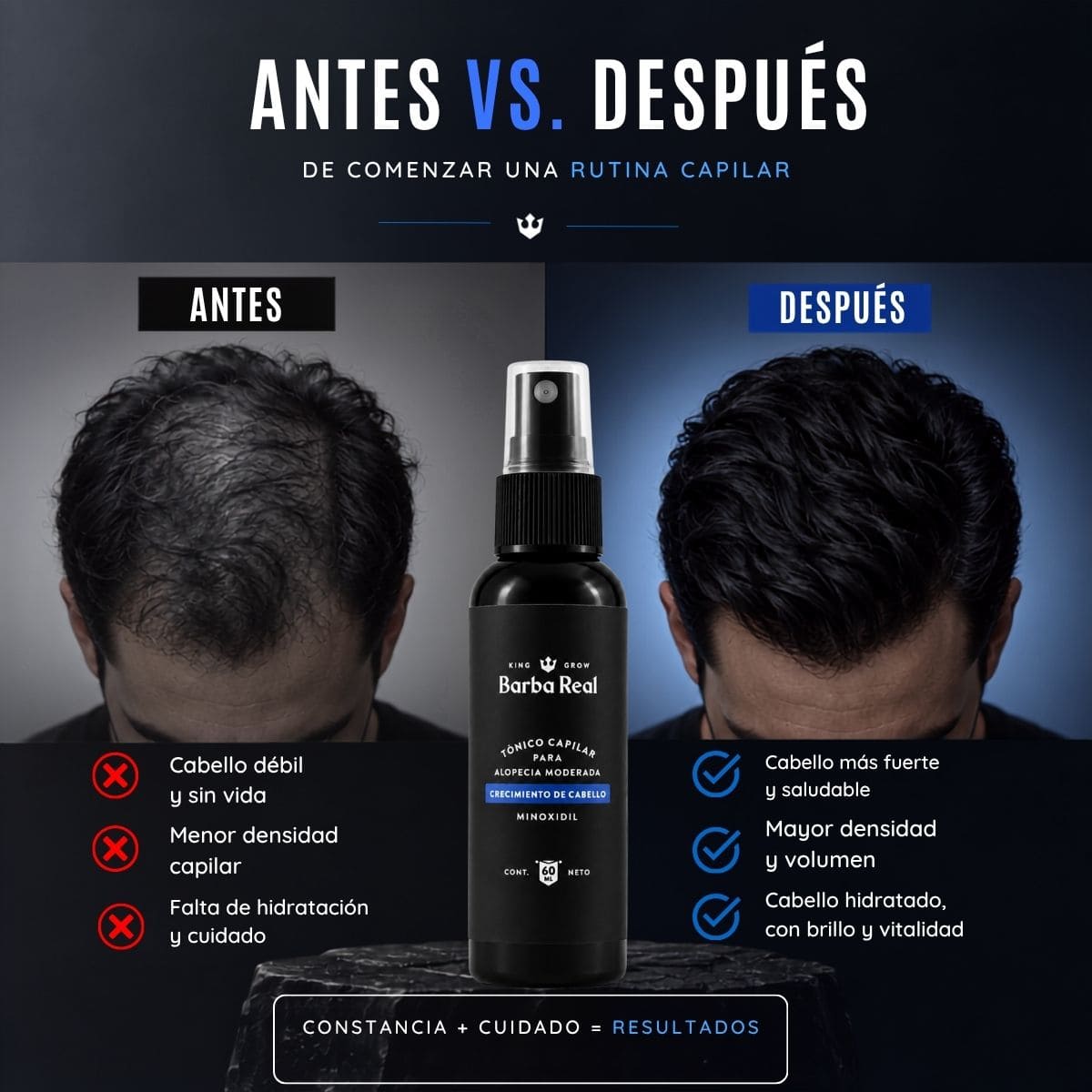 Minoxidil al 13% | Spray para Crecimiento de Cabello. Reduce la Alopecia. - BarbaReal