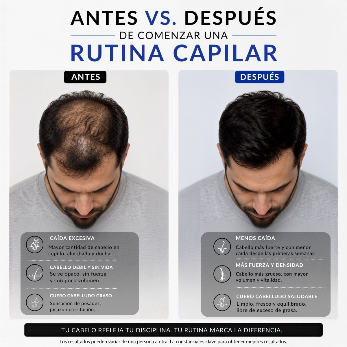 Shampoo con Minoxidil | Fortalece el cabello y detiene la caída - BarbaReal
